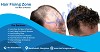 HAIR FIXING ZONE Offers instant solution for Hair loss