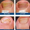 San Diego Laser Nail Fungus Removal Clinic