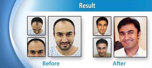 Hair Transplant In Lahore