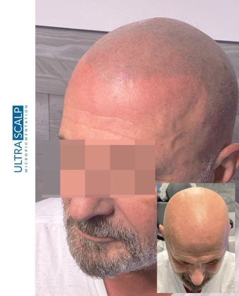 Ultra Scalp Micropigmentation