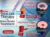 Affordable Stem Cell Therapy for Your Brain Stroke Treatment