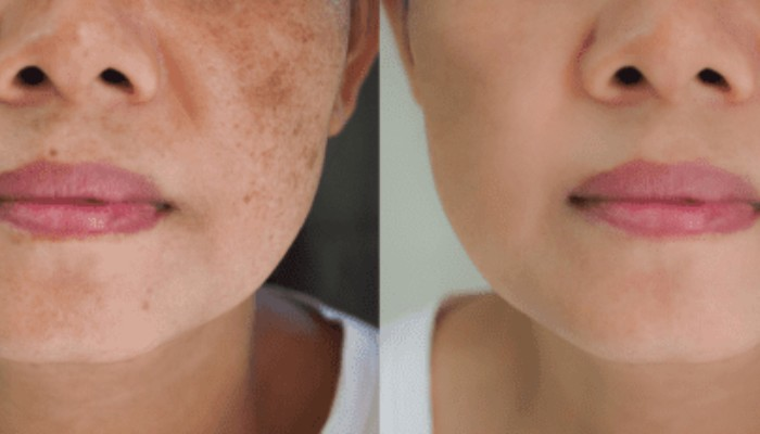 Anti Pigmentation Treatment in Koregaon Park, Pune