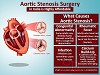 Aortic Stenosis Surgery in India is Highly Affordable
