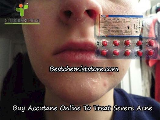Buy Accutane Online To Treat Severe Acne