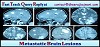 Metastatic Brain Lesions treated with Gamma Knife Procedure in India