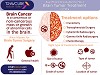 Avail Free Consultation for Your Brain Tumor Treatment in India