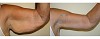 Upper Arm Lift/Reduction (Brachioplasty) at Elite Surgical
