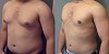 Reduce Male Breast Size