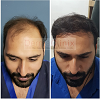 Another dramatic transformation |B.E.S.T. (Bio-Enhanced Simultaneous Transplant Technique) FUE | Dr.