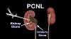 PCNL Surgery in India
