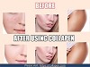 Purchase Micro Needling Pen