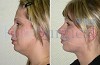 Affordable Neck Lift Surgery at Elite Surgical