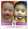 Why Richardsons for Cleft Lip and Palate?