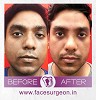 Nose Surgery in India - How Ethnicity Determines the Surgical Procedure