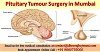 Average Cost Pituitary Tumour Surgery in Mumbai found very Reasonable by Medical Tourists