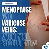 MENOPAUSE AND VARICOSE VEINS: EVERYTHING YOU NEED TO KNOW