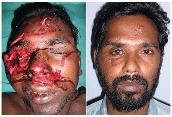 Trauma Surgery | Facial Fracture Treatment In India | Richardsons Dental
