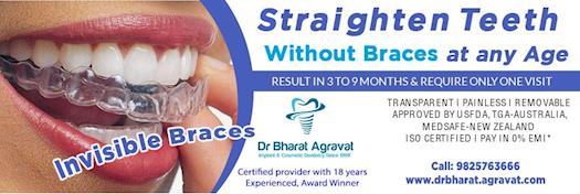  Invisible clear braces for teeth cost, price, reviews, pros-cons, before-after from India’s leading