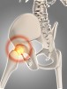 Types of Hip Replacement Surgeries and their costs