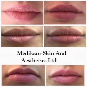 Best Lip Fillers Treatment in London - New Face & Body Solutions