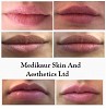 Best Lip Fillers Treatment in London - New Face & Body Solutions