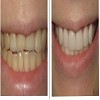 Before and After Photos of Porcelain Veneers