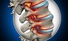 Spinal Cord Stimulation Charleston SC
