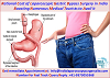 Rational Cost of Laparoscopic Gastric Bypass Surgery in India Boosting Numerous Medical Tourists to 