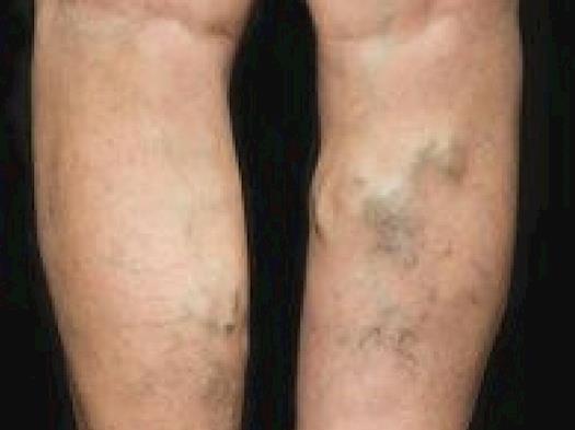 Varicose Veins Are A Real Risk To Your Health