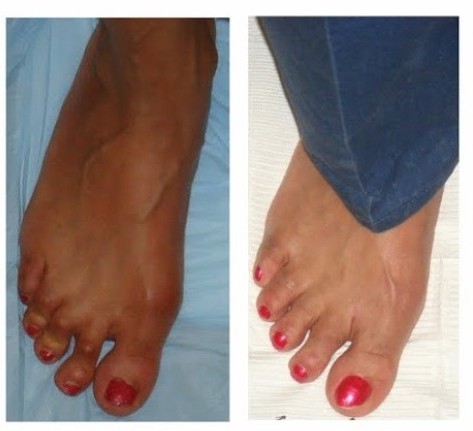 Hammertoe Before and After Procedure
