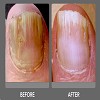 Laser Nail Fungus San Diego Costs
