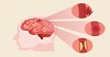  Stroke affects different parts of the Brain
