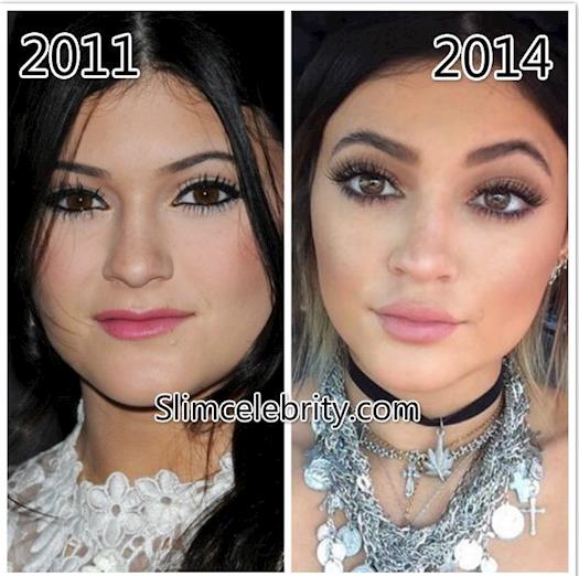 Before And After Pics Of Kylie Jenner Plastic Surgery