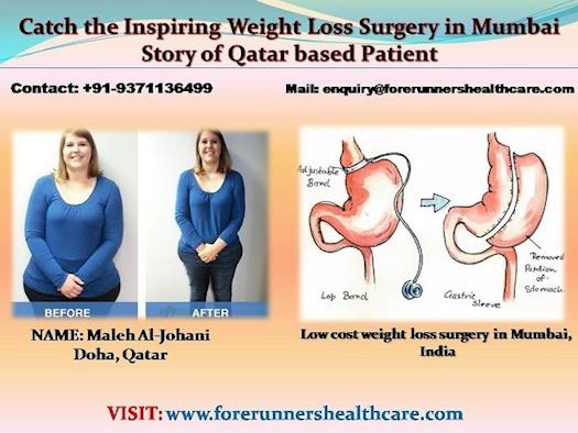 Catch the Inspiring Weight Loss Surgery in Mumbai Story of Qatar based Patient 
