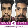 Facial Hair Transplantation for Mustache - Facesurgeon