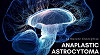 Anaplastic Astrocytoma - Pipeline Review, H2 2017