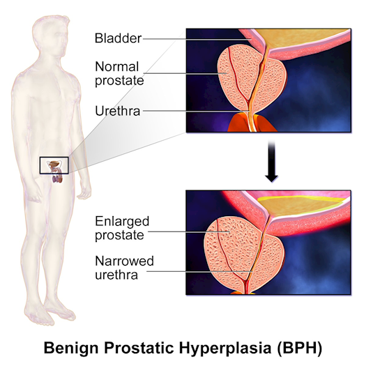 US Benign Prostatic Hyperplasia