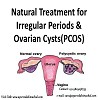 Natural treatment for PCOS/PCOD
