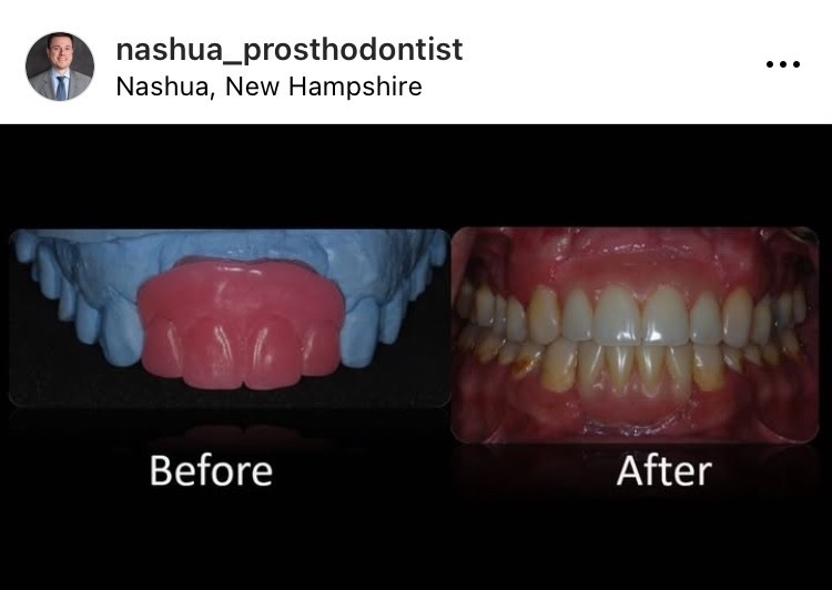 Dental Implants Nashua