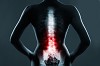 Get Treatment of Spinal Fractures and Osteoporosis - USA Vascular Centers