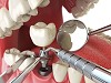 Dental Implants Costs Snellville