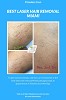 Best Laser Hair Removal Miami- a way to look dashing