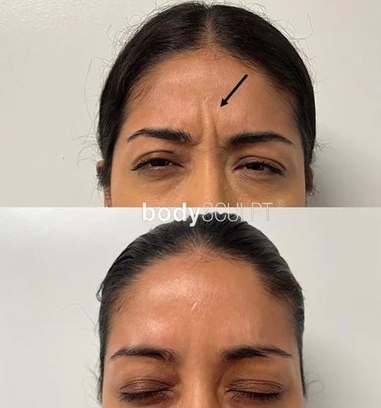 BOTOX - BEFORE & AFTER PHOTOS