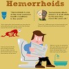What Are Hemorrhoids?