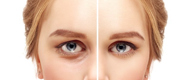 Treat vision problems with blepharoplasty treatment in Chesapeake