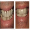Before and After Photos of Full Mouth Reconstruction