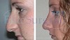 Affordable Rhinoplasty at Elite Surgical