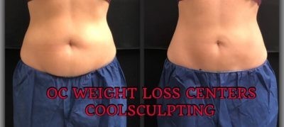 Coolsculpting in Orange County - OC Weight Loss Centers