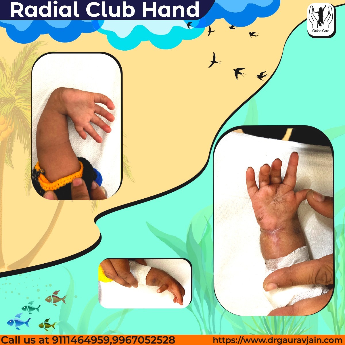 Radial Club Hand Treatment in Indore
