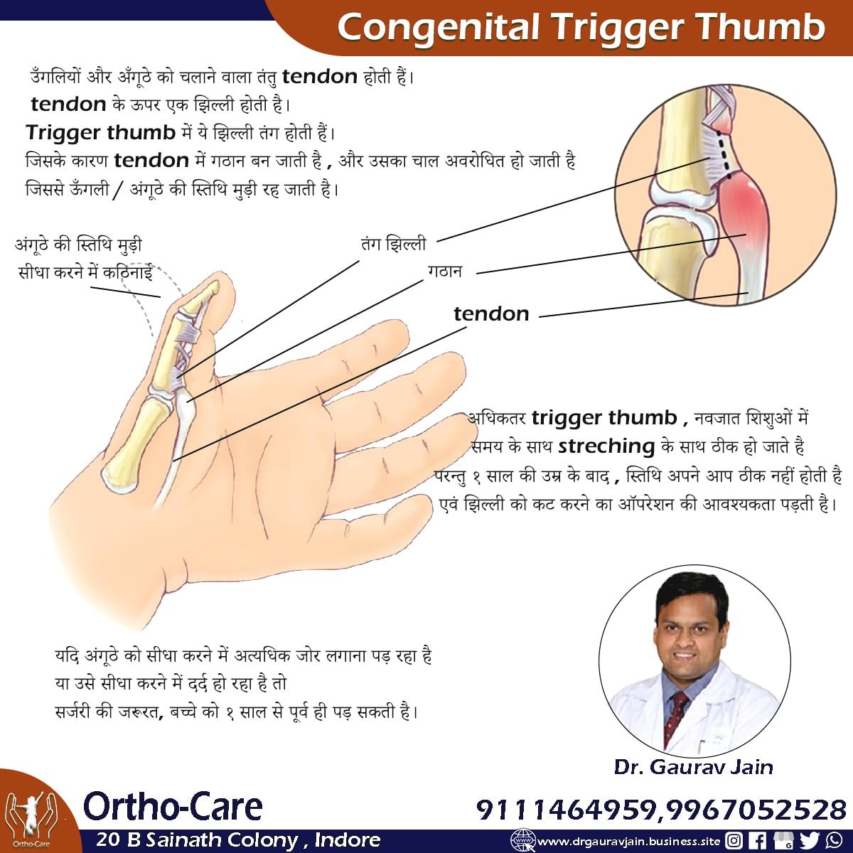 Congenital Trigger thumb treatment in indore